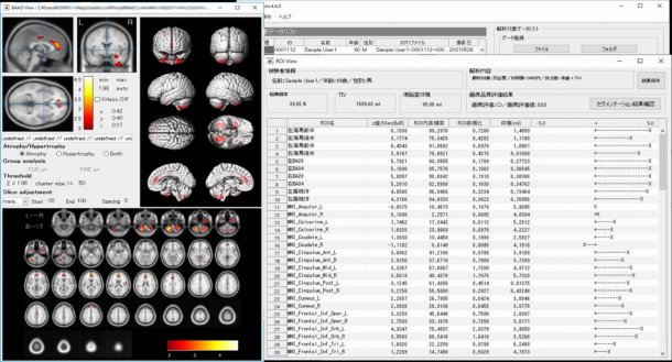 脳画像解析プログラム BAAD